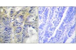 Immunohistochemistry analysis of paraffin-embedded human colon carcinoma tissue, using Collagen IV alpha5 Antibody.