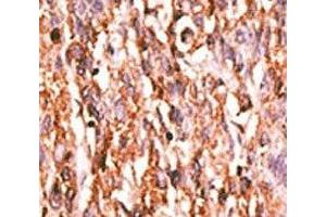 IHC analysis of FFPE human hepatocarcinoma tissue stained with the phospho-KDR antibody.