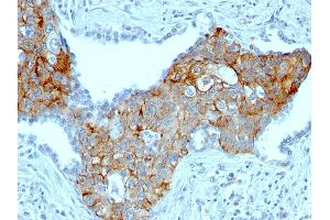 Formalin-fixed, paraffin-embedded human Lung SqCC stained with TRIM29 Mouse Monoclonal Antibody (TRIM29/1041). (TRIM29 anticorps  (AA 1-200))