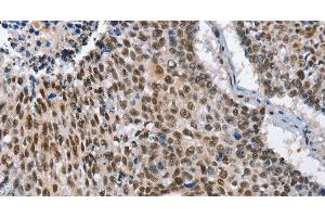 Immunohistochemistry of paraffin-embedded Human lung cancer tissue using GNRH1 Polyclonal Antibody at dilution 1:65 (GNRH1 anticorps)