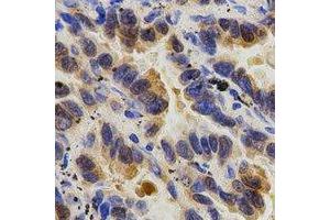 Immunohistochemical analysis of Caspase 9 p35 staining in human lung cancer formalin fixed paraffin embedded tissue section. (Caspase 9 p35 anticorps)