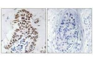 Immunohistochemistry analysis of paraffin-embedded human lung carcinoma tissue using DAPK3 (Ab-265) antibody.