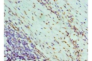 Immunohistochemistry of paraffin-embedded human colon cancer using ABIN7161690 at dilution of 1:100 (NONO anticorps  (AA 1-300))
