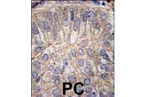 Formalin-fixed and paraffin-embedded human prostate carcinoma tissue reacted with CDH3 antibody , which was peroxidase-conjugated to the secondary antibody, followed by DAB staining. (P-Cadherin anticorps  (C-Term))
