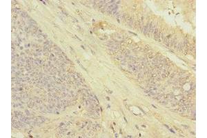 Immunohistochemistry of paraffin-embedded human colon cancer using ABIN7154564 at dilution of 1:100 (GRPEL2 anticorps  (AA 33-225))