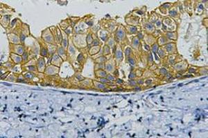 Immunohistochemistry (IHC) staining of Human Breast cancer tissue, diluted at 1:200. (ErbB2/Her2 anticorps)