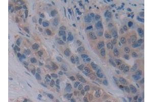 Detection of ChAT in Human Breast cancer Tissue using Polyclonal Antibody to Choline Acetyltransferase (ChAT)