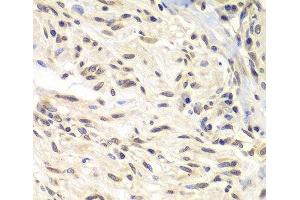Immunohistochemistry of paraffin-embedded Human gastric cancer using CHEK1 Polyclonal Antibody at dilution of 1:100 (40x lens). (CHEK1 anticorps)