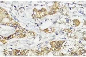 Immunohistochemistry of paraffin-embedded Human liver cancer using HACE1 Polyclonal Antibody at dilution of 1:100 (40x lens).