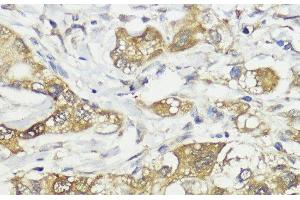 Immunohistochemistry of paraffin-embedded Human liver cancer using HACE1 Polyclonal Antibody at dilution of 1:100 (40x lens). (HACE1 anticorps)