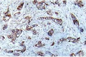 Immunohistochemistry (IHC) analyzes of p-CaMK2-a antibody in paraffin-embedded human breast carcinoma tissue. (CAMK2A anticorps  (pThr286))
