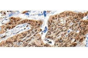 Immunohistochemistry of paraffin-embedded Human esophagus cancer tissue using XPO1 Polyclonal Antibody at dilution of 1:40(x200) (XPO1 anticorps)