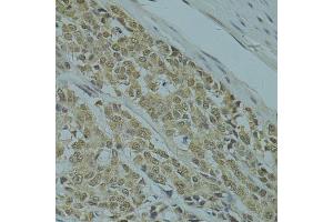 Immunohistochemistry of paraffin-embedded human colon carcinoma using RSRC1 antibody (ABIN5974341) at dilution of 1/100 (40x lens). (RSRC1 anticorps)
