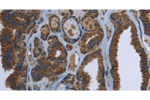 Immunohistochemistry of paraffin-embedded Human thyroid cancer using GCK Polyclonal Antibody at dilution of 1:40 (GCK anticorps)