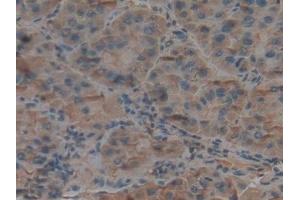 Detection of C3 in Human Liver cancer Tissue using Polyclonal Antibody to Complement Component 3 (C3)