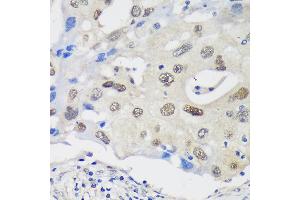 Immunohistochemistry of paraffin-embedded Human breast cancer using UCKL1 Rabbit pAb (ABIN7271233) at dilution of 1:100 (40x lens). (UCKL1 anticorps  (AA 1-200))