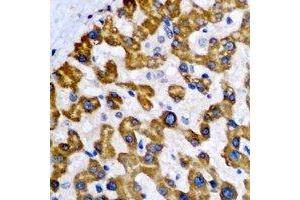 Immunohistochemical analysis of NDUFA2 staining in human liver cancer formalin fixed paraffin embedded tissue section.