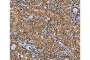 Immunohistochemistry of Human thyroid cancer using TRIM29 Polyclonal Antibody at dilution of 1:50 (TRIM29 anticorps)
