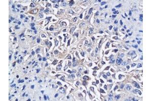 Formalin-fixed and paraffin embedded mouse hepatic tumor labeled with Anti-CD150/SLAMF1 Polyclonal Antibody, Unconjugated (ABIN749468) followed by conjugation to the secondary antibody and DAB staining (SLAMF1 anticorps  (AA 231-335))