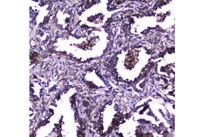 IHC testing of FFPE human lung cancer tissue with TLR1 antibody at 1ug/ml. (TLR1 anticorps)