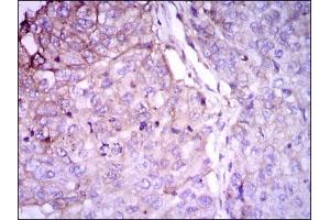 Immunohistochemical analysis of paraffin-embedded lung cancer tissues using RAB4A mouse mAb with DAB staining. (Rab4 anticorps)