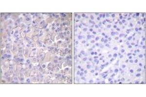 Immunohistochemistry analysis of paraffin-embedded human breast carcinoma, using EGFR (Phospho-Thr693) Antibody. (EGFR anticorps  (pThr693))