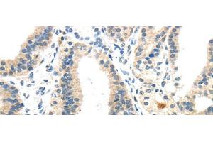 Immunohistochemistry of paraffin-embedded Human thyroid cancer using INHBB Polyclonal Antibody at dilution of 1/40 (INHBB anticorps)