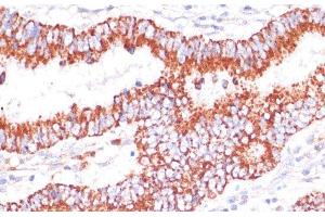 Immunohistochemistry of paraffin-embedded Human colon carcinoma using ENTPD6 Polyclonal Antibody at dilution of 1:100 (40x lens). (ENTPD6 anticorps)