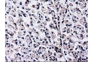 Immunohistochemical staining of paraffin-embedded Adenocarcinoma of Human colon tissue using anti-CTNNB1 mouse monoclonal antibody. (CTNNB1 anticorps)