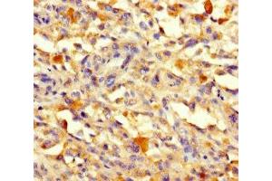 Immunohistochemistry of paraffin-embedded human melanoma using ABIN7171199 at dilution of 1:100 (Sorting Nexin 1 anticorps  (AA 1-250))
