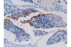 IHC-P analysis of Human Lung Cancer Tissue, with DAB staining. (c-MET anticorps  (AA 1092-1379))