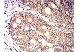 Immunohistochemical analysis of paraffin-embedded cervical cancer tissues using KIR3DL1 mouse mAb with DAB staining. (KIR3DL1 anticorps  (AA 22-340))