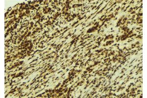 ABIN6274262 at 1/100 staining Human breast cancer tissue by IHC-P. (CSNK1A1 anticorps  (Internal Region))