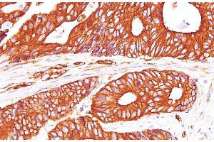 Immunohistochemistry of paraffin-embedded Human carcinoma of Colon using Sptan1 Polyclonal Antibody at dilution of 1:100(400x) (SPTAN1 anticorps)