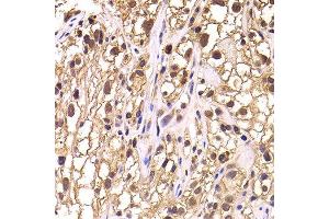 Immunohistochemistry of paraffin-embedded human kidney cancer using TCEB3 antibody at dilution of 1:100 (x400 lens). (TCEB3 anticorps)
