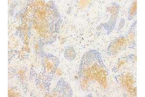 ABIN7096990 and ABIN7101057 at 1/100 staining human breast carcinoma by IHC-P. (ADSSL1 anticorps)