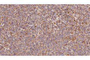 ABIN6273193 at 1/100 staining Human lymph cancer tissue by IHC-P. (ARHGDIB anticorps  (N-Term))