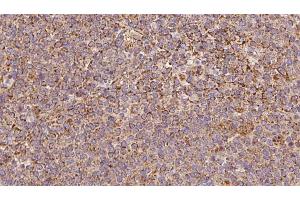 ABIN6273193 at 1/100 staining Human lymph cancer tissue by IHC-P. (ARHGDIB anticorps  (N-Term))