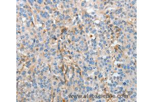 Immunohistochemistry of Human esophagus cancer using APOH Polyclonal Antibody at dilution of 1:30 (APOH anticorps)