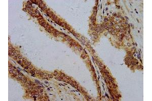 IHC image of ABIN7162643 diluted at 1:700 and staining in paraffin-embedded human prostate cancer performed on a Leica BondTM system. (PTH anticorps  (AA 32-115))