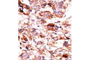 Formalin-fixed and paraffin-embedded human cancer tissue reacted with the primary antibody, which was peroxidase-conjugated to the secondary antibody, followed by AEC staining. (ADCK5 anticorps  (C-Term))