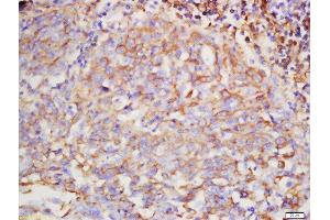 Formalin-fixed and paraffin embedded human lung carcinoma labeled with Rabbit Anti-Hyaluronidase2 Polyclonal Antibody, Unconjugated  at 1:200 followed by conjugation to the secondary antibody and DAB staining