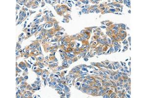 Immunohistochemical analysis of paraffin-embedded Human lung cancer tissue using at dilution 1/50. (CCL23 anticorps  (C-Term))