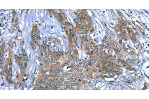Immunohistochemistry of paraffin-embedded Human cervical cancer using SCPEP1 Polyclonal Antibody at dilution of 1:30 (SCPEP1 anticorps)