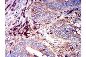 Immunohistochemical analysis of paraffin-embedded rectum cancer tissues using CD97 mouse mAb with DAB staining.