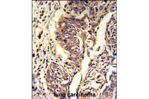 Formalin-fixed and paraffin-embedded human lung carcinoma reacted with KYNU Antibody , which was peroxidase-conjugated to the secondary antibody, followed by DAB staining. (KYNU anticorps  (C-Term))