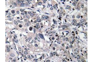 Immunohistochemical analysis of paraffin-embedded human liver carcinoma tissue using CYP2C19 polyclonal antibody . (CYP2C19 anticorps)