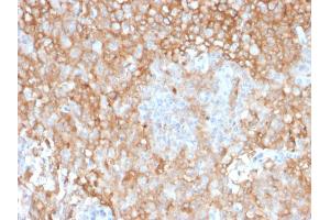 Formalin-fixed, paraffin-embedded human Lung Tumor stained with HLA-DR Mouse Monoclonal Antibody (TAL 1B5). (HLA-DR anticorps)