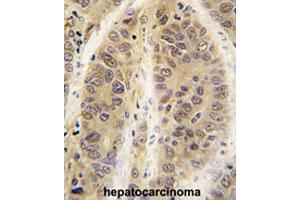 Formalin-fixed and paraffin-embedded human hepatocarcinomareacted with ADK polyclonal antibody , which was peroxidase-conjugated to the secondary antibody, followed by AEC staining.