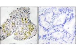 Immunohistochemistry analysis of paraffin-embedded human lung carcinoma tissue, using LKB1 (Ab-428) Antibody. (LKB1 anticorps  (AA 384-433))